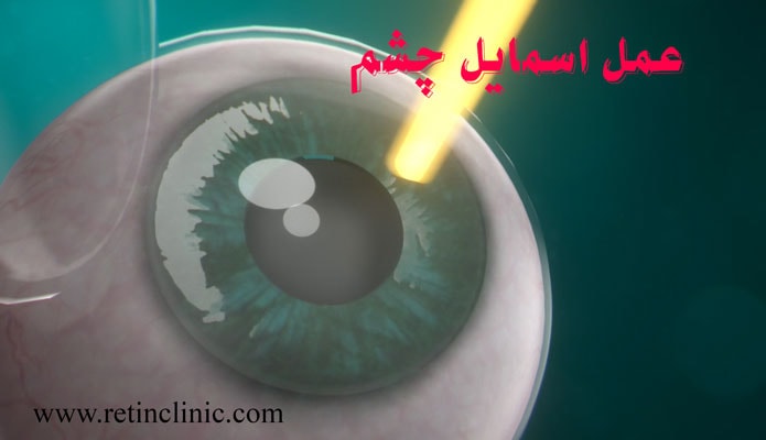 عمل اسمایل چشم