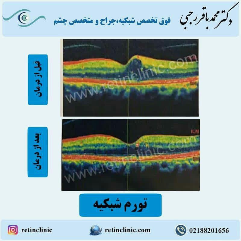 تورم شبکیه