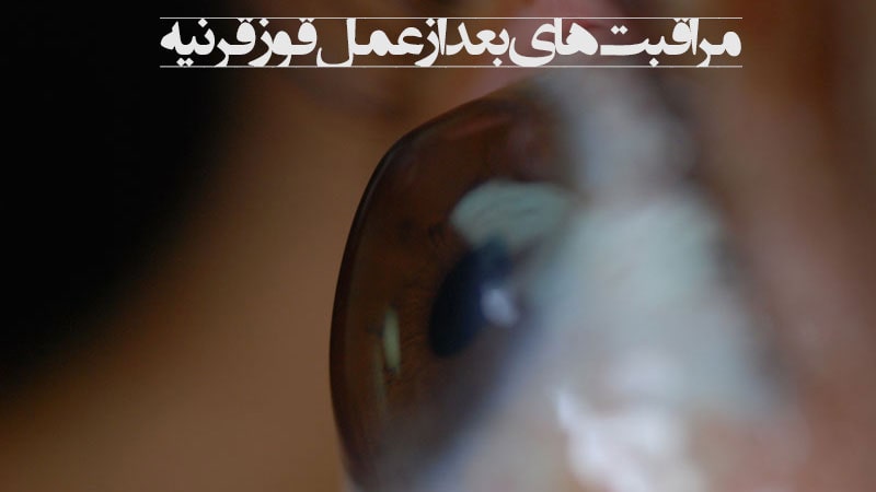 مراقبت های بعد از عمل قوز قرنیه