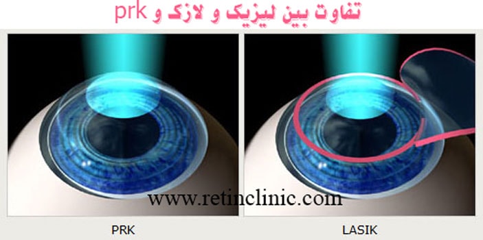 تفاوت بین لیزیک و لازک و prk