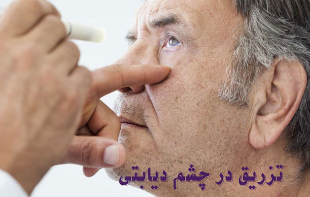 تزریق در چشم دیابتی