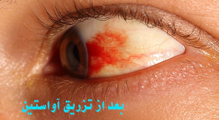 بعد از تزریق آواستین