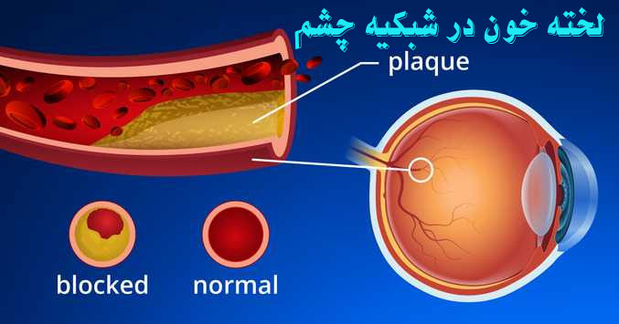 لخته خون در شبکیه چشم