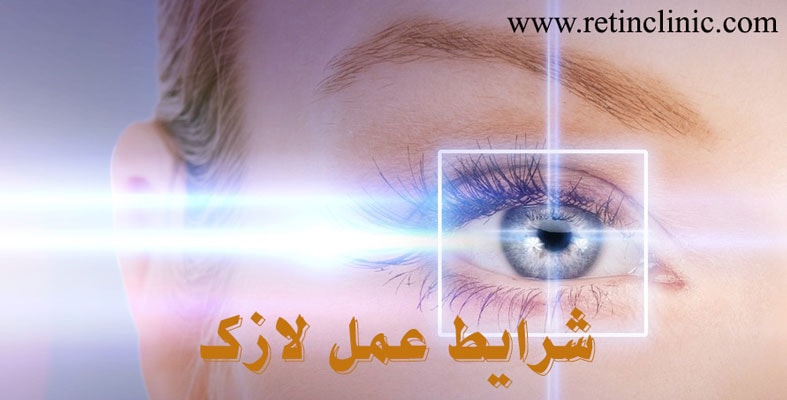 شرایط عمل لازک