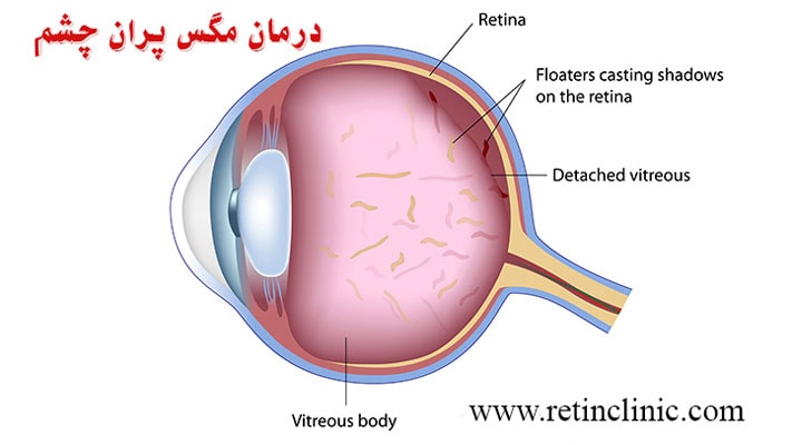 جدیدترین درمان مگس پران