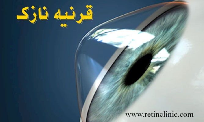 قرنیه نازک