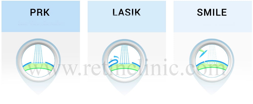 تفاوت عمل اسمایل چشمی با لیزیک