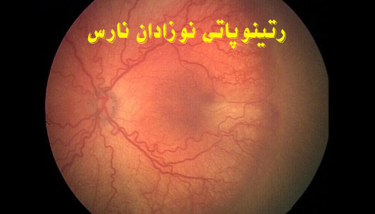 رتینوپاتی نوزادان نارس