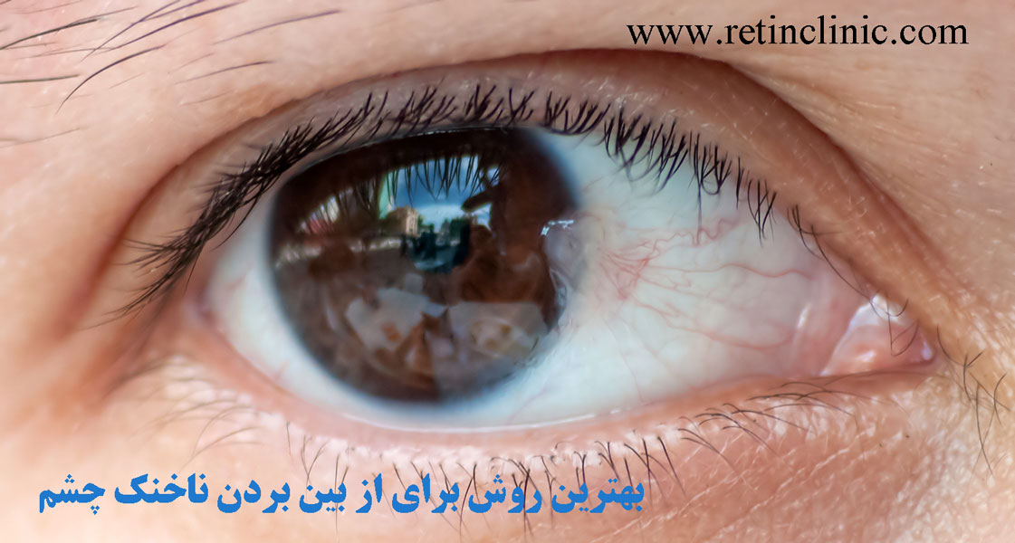 بهترین روش برای از بین بردن ناخنک چشم