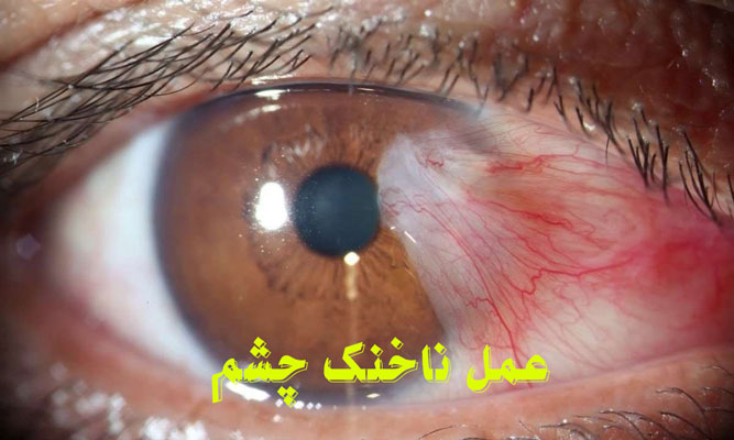 عمل ناخنک چشم