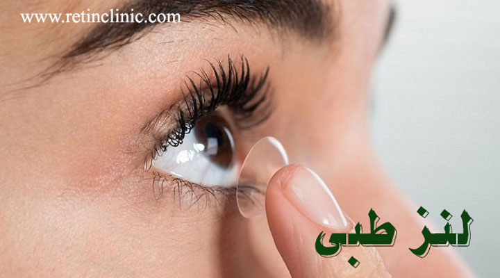 لنز طبی