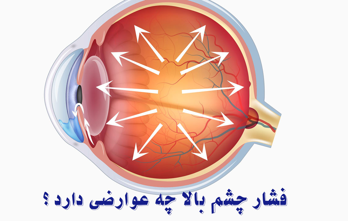 فشار چشم بالا چه عوارضی دارد
