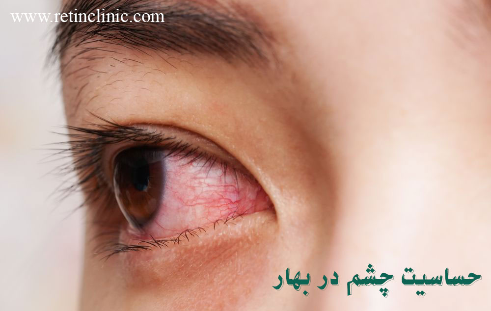 حساسیت چشم در بهار