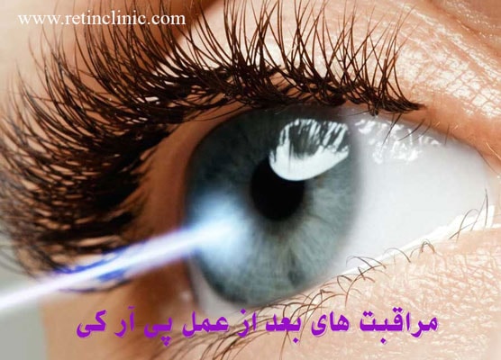 مراقبت های بعد از عمل پی آر کی
