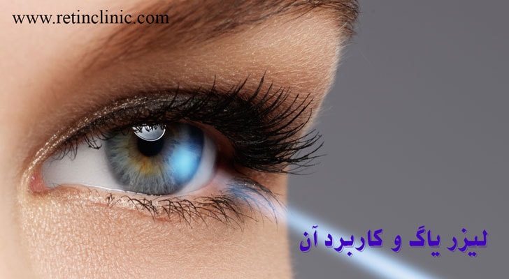 لیزر یاگ