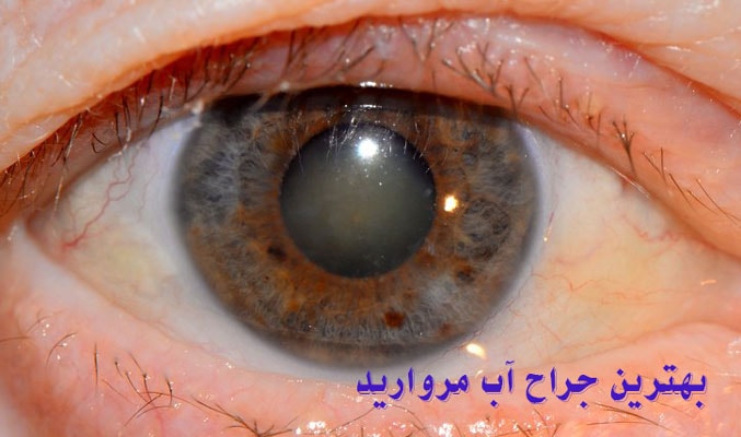 بهترین جراح آب مروارید