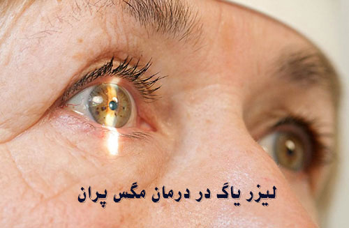 درمان مگس پران با لیزر yag