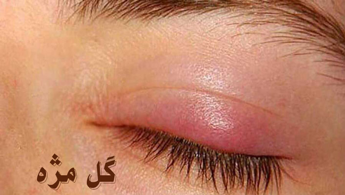 گل مژه