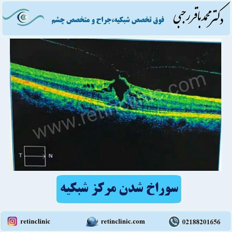 سوراخ شدن مرکز شبکیه