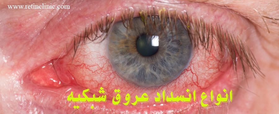 انواع انسداد عروق شبکیه