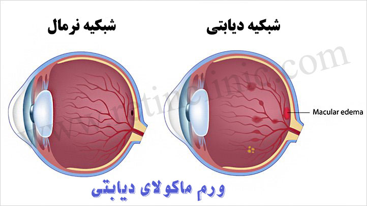 ورم ماکولای دیابتی