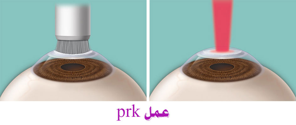 Prk