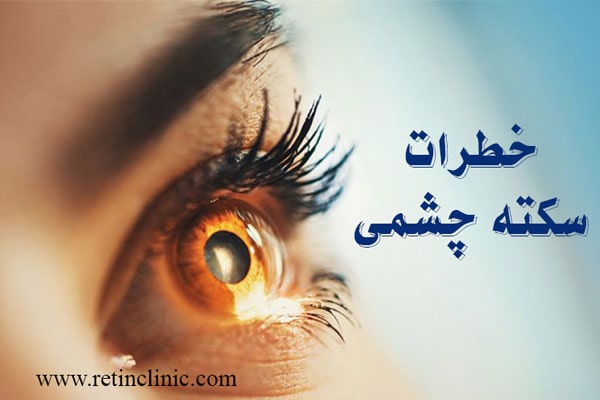 خطرات سکته چشمی