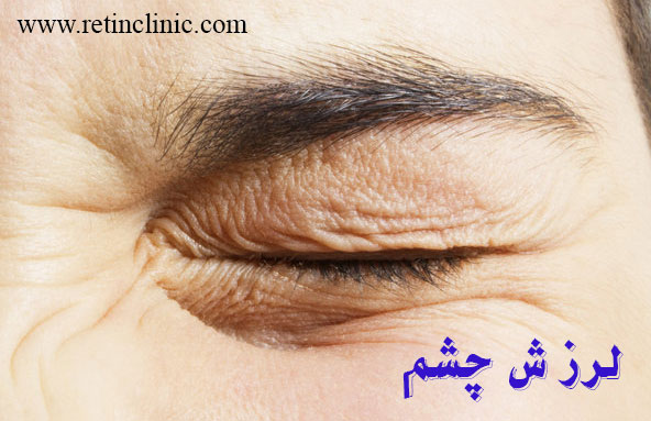 لرزش چشم