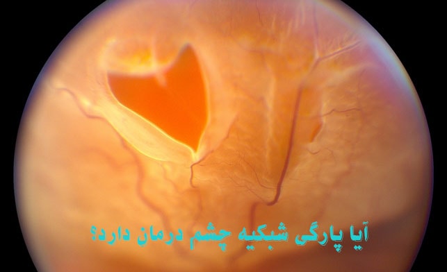 پارگی شبکیه چشم درمان دارد