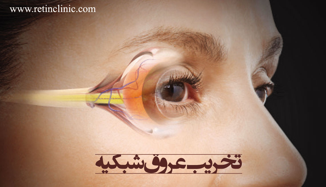 تخریب عروق شبکیه چشم