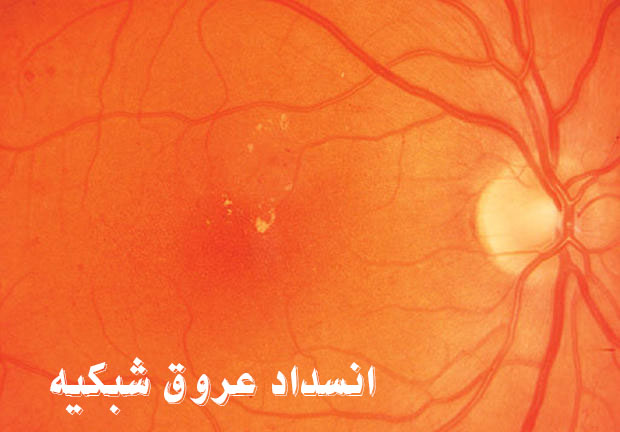 انسداد و گرفتگی عروق شبکیه