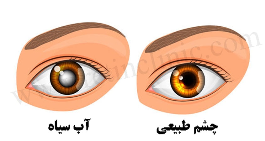 آب سیاه