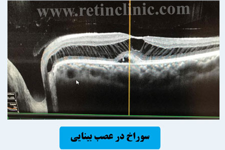 جراحی ویترکتومی سوراخ در عصب بينايی