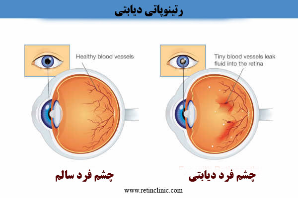  بیماری رتینوپاتی دیابتی