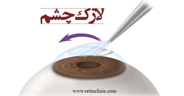 لازک چشم