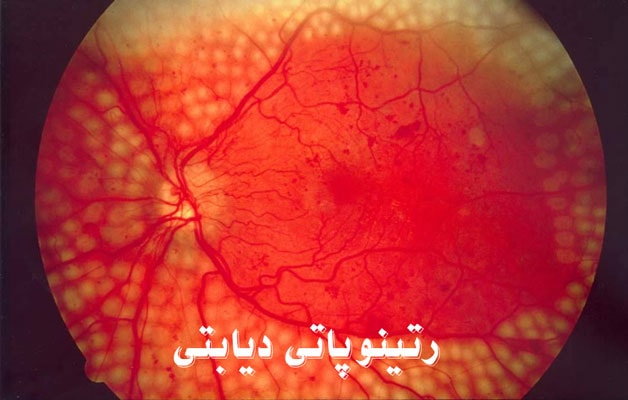 رتینوپاتی دیابتی