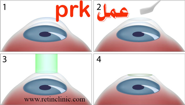 عمل prk