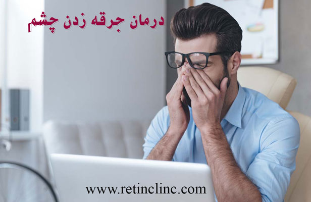 درمان جرقه زدن چشم