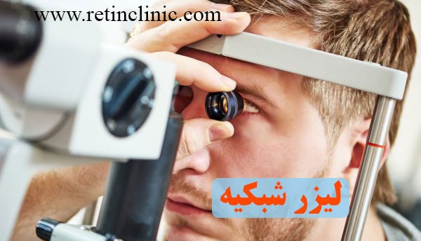 لیزر شبکیه