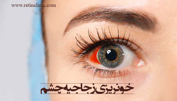 خونریزی زجاجیه