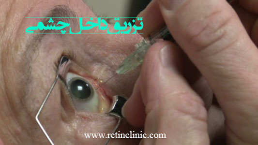 تزریق داخل چشمی