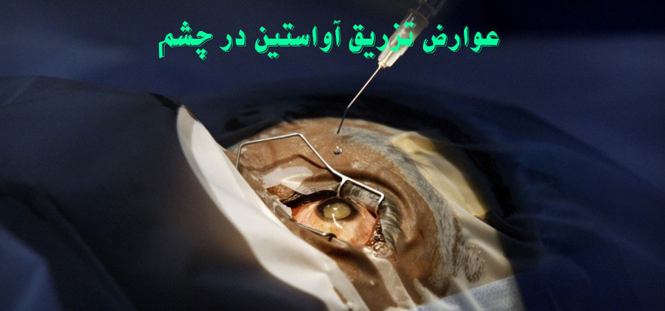 عوارض تزریق آواستین در چشم