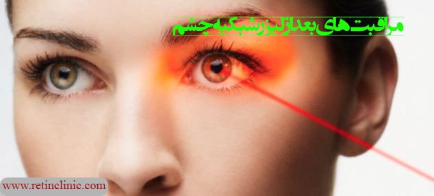 مراقبتهای بعد از لیزر شبکیه چشم