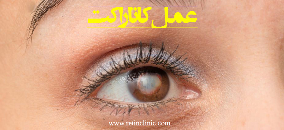 عمل کاتاراکت