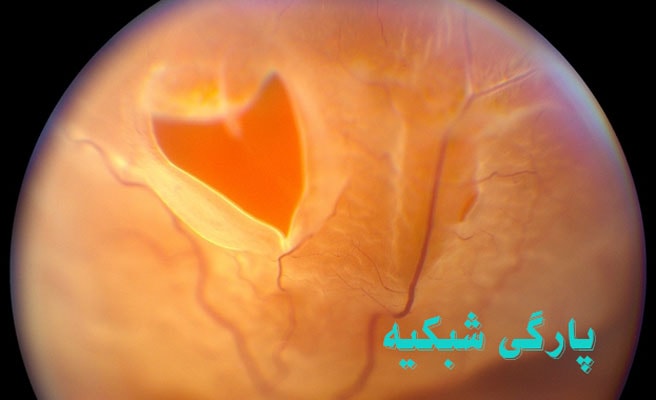 پارگی شبکیه