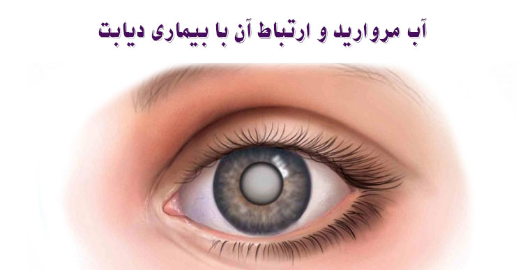 آب مروارید و ارتباط آن با بیماری دیابت