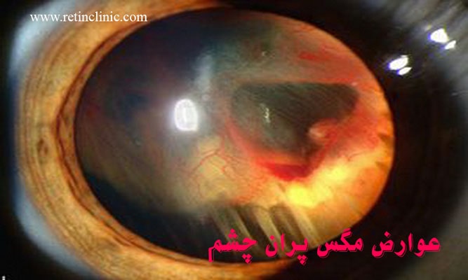 عوارض مگس پران چشم