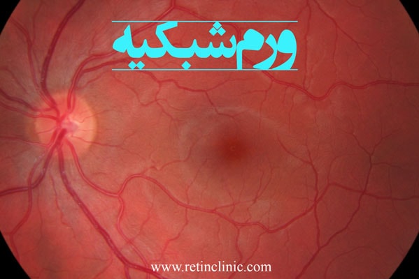 ورم شبکیه