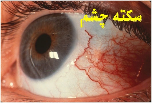 سکته چشم