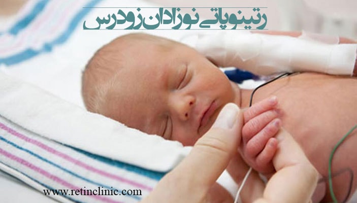 رتینوپاتی نوزادان زودرس
